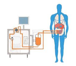 HIPEC TREATMENT in Hyderabad